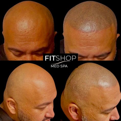 scalp micropigmentation albuquerque|Fitshop Med Spa .